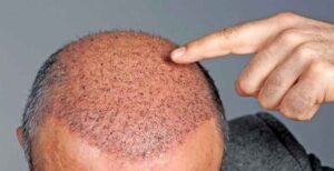 চুল প্রতিস্থাপনের পরে হতে পারে যেসব সমস্যা