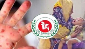 দেশে হাম উপসর্গে শিশু মৃত্যু আড়াইশ ছাড়াল