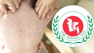 বাড়ছে হাম সংক্রমণ, একদিনে আরও ৭ শিশুর প্রাণহানি