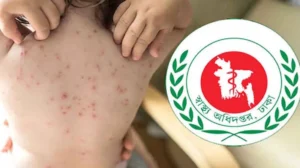 হাম ও হামের উপসর্গে আরও ৭ শিশুর মৃত্যু