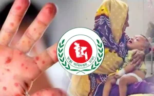 হাম ও হামের উপসর্গ নিয়ে ২৪ ঘণ্টায় ১০ জনের মৃত্যু