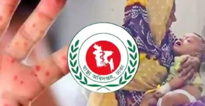 ঢাকায় হামের উপসর্গে আরও ৬ জনের মৃত্যু, ২৪ ঘণ্টায় শনাক্ত ৭৮