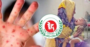 হামে ও উপসর্গে মৃতের সংখ্যা পৌঁছাল ৭৯৩, একদিনে প্রাণ গেল আরও ৫ শিশুর